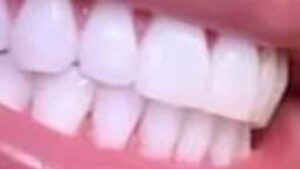 Teeth Whitening Remedies