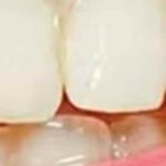 Natural Teeth Whitening Hacks