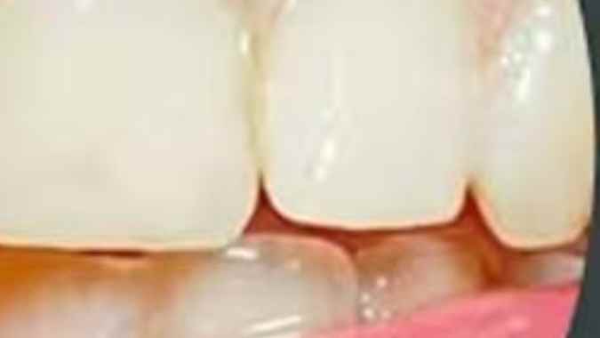 Natural Teeth Whitening Hacks