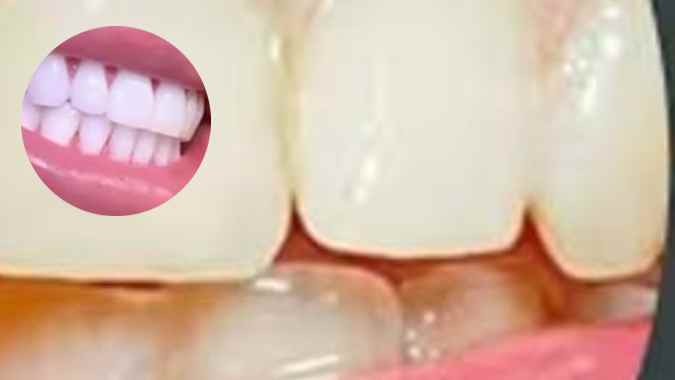 Teeth Whitening Remedies